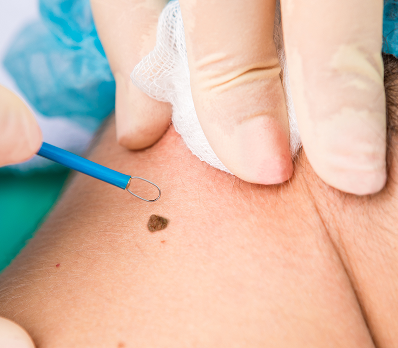 Dermatologia cirúrgica — remoção de lesões